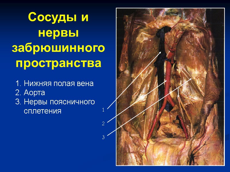 Сосуды и нервы  забрюшинного пространства 1  2  3 Нижняя полая вена
